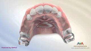 Orthodontic Space Management  Nance Appliance [upl. by Thorpe]