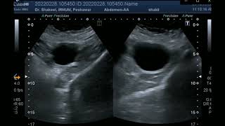 Adnexal Simple Cyst adnexalcyst [upl. by Sheffield]