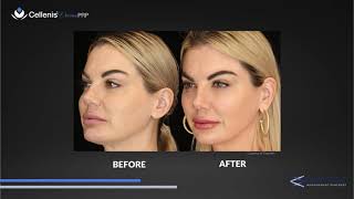 Cellenis Derma PRP Before amp After Pictures [upl. by Denna283]