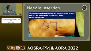 PNS GUIDED ILIOINGUINAL ILIOHYPOGASTRIC NERVE BLOCK [upl. by Assirehc443]