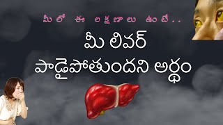 Liver symptoms Telugu కామెర్లు – వాటి లక్షణాలు Jaundice symptoms  Kamerlu  jaundice lakshanalu [upl. by Ramilahs]