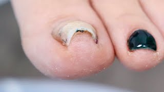 Super CURVED INGROWN Toenail PLUS NAIL REMOVAL [upl. by Animrelliug544]