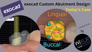 exocad Custom Abutment Design Todays Case [upl. by Ahsenit]