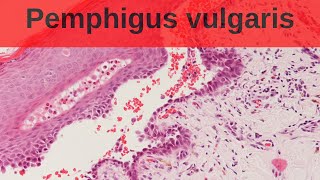 Pemphigus Vulgaris  Pathology mini tutorial [upl. by Bondon487]