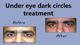 Fix the Root Cause of Dark Circles Under the Eyes [upl. by Otrebor]