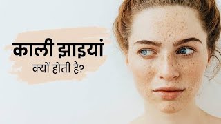 चेहरे की झाई  remove pigmentation  remedy of melasma  elocon cream  Freckles face  Jhaiya [upl. by Aneehsit]