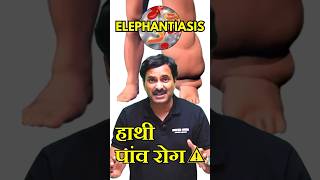 Elephantiasis Filariasis  हाथी पांव रोग 😰 disease neetpreparation neetexam [upl. by Ris95]