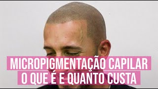 Como é feito a micropigmentação capilar e quanto custa Preço Médio [upl. by Veronika586]