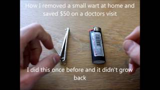 Removing wart with nail clippers and bic lighter Saved 50 in 2 minutes [upl. by Kele]