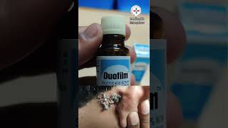 duofilm lotion for warts corn calluses [upl. by Odlareg]