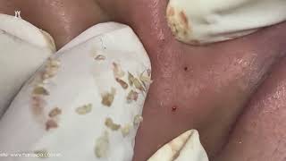 Big Cystic Acne Blackheads Extraction Blackheads amp Milia Whiteheads Removal Pimple Popping [upl. by Guendolen]