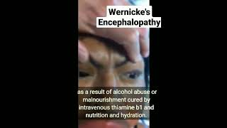 Wernickes Encephalopathy [upl. by Ahsenet577]