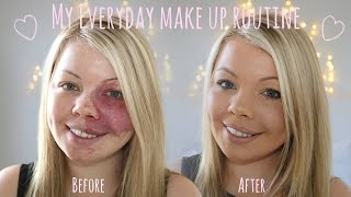 My Everyday Make Up Routine  Birthmark Coverage  Amy Elsegood [upl. by Jews931]