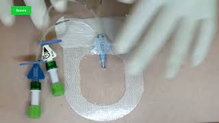 3M™ Tegaderm™ Antimicrobial IV Advanced Securement Dressing 9132 Application and Removal video [upl. by Hallsy986]