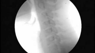 Pierce Results System Chiropractic Videofluoroscopy Tutorial Case 1 [upl. by Aissert]