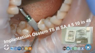 Implantatioin Osstem TS III SA in plase of tooth 46 FHD multistream [upl. by Notreb329]