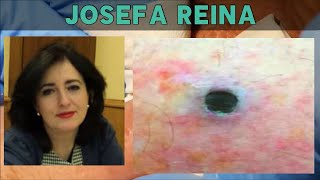 What Happened to Josefa Reina Dr ER Russ Hamstring and Karma Blackheads [upl. by Jule]