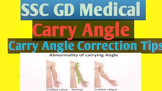 SSC GD Medical Carry Angel Correction Exercisesscgd [upl. by Mcleroy]