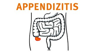 Die Appendizitis  Ausschnitt aus der Lernplattform der arche medica [upl. by Gunilla]