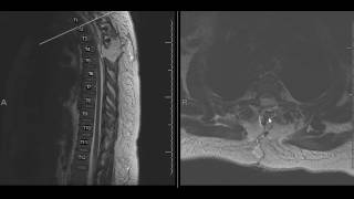 Spinal arachnoid cystmeningeal cyst [upl. by Asteria]