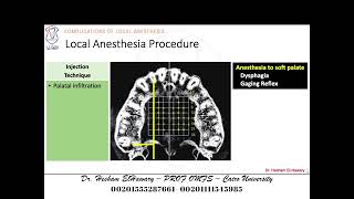 05 Complications Of Local Anesthesia Related To Utilized Technique [upl. by Eevets872]