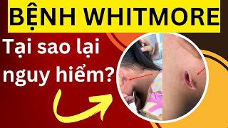 Bệnh Whitmore là gì Tại sao vi khuẩn gây bệnh Whitmore được xem như quotvi khuẩn ăn thịt ngườiquot [upl. by Creigh917]