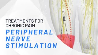 Peripheral Nerve Stimulation  What You Need To Know [upl. by Danit]