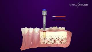 DENTIS Dental Guide System  SIMPLE GUIDE Plus Korean [upl. by Vi720]