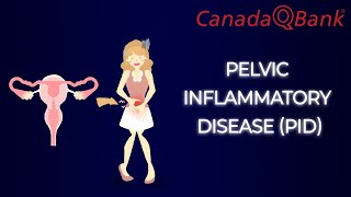 Pelvic Inflammatory Disease PID [upl. by Bent210]