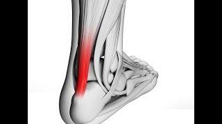 What is Achilles Tendonitis [upl. by Wake515]