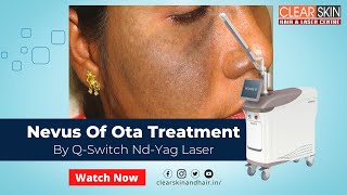 Nevus Of Ota Treatment by Q Switch Nd YAG Laser Helios  Nevus of OTA  Birth Mark  Laser Treatment [upl. by Fons]