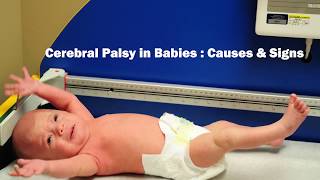 What are the main causes amp signs of Cerebral Palsy in babies  Dr Vykunta Raju K N [upl. by Cami]