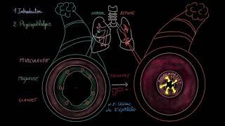 Asthme  Introduction  Physiopathologie  Triggers  Signes et symptomes [upl. by Sugar]