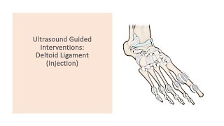 ultrasound Guided Interventions Deltoid ligament injection fyp sport sports sportsmedicine [upl. by Ardien]