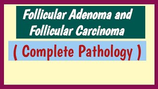 Follicular Adenoma And Follicular Carcinoma  Thyroid Neoplasm [upl. by Bounds589]