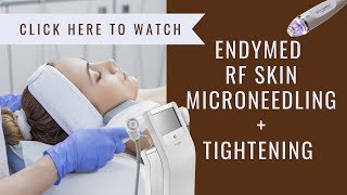 EndyMed RF Skin Tightening  Microneedling at Avery Graham Aesthetics [upl. by Hayidah70]