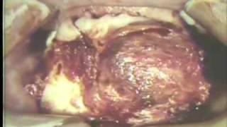 Removal of Large Ameloblastoma of Mandible [upl. by Coffin991]