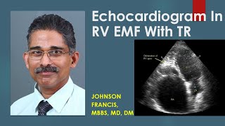 Echocardiogram In Right Ventricular Endomyocardial Fibrosis With Tricuspid Regurgitation [upl. by Jsandye]