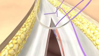 Abdominal Wall Closure BBraun [upl. by Tnecnivleahcim]