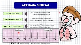 2 ARRITMIAS SINUSALES KAREN MAMANI [upl. by Kind]