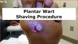 Plantar Wart Shaving Procedure [upl. by Ameluz]