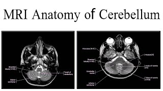 MRI Anatomy of cerebellum [upl. by Evatsug3]