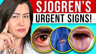 10 Signs of Sjogrens Syndrome  a very complex autoimmune disease [upl. by Tahpos]