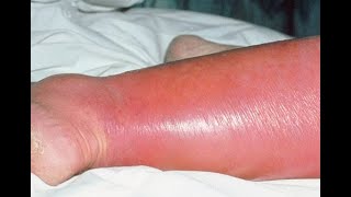 Cellulitis and Erysipelas Intro and Diagnosis [upl. by Sadnac719]