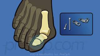 PreOp® Bunion Foot Surgery [upl. by Teeter937]