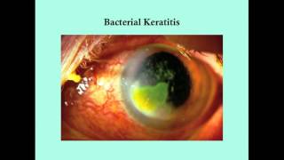 Keratitis  CRASH Medical Review Series [upl. by Anytsirk]