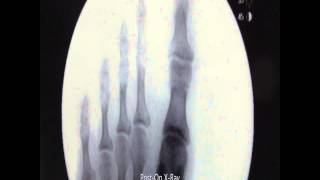 Bilateral Akin Osteotomy Hammertoe Correction With XRays [upl. by Lemahs982]