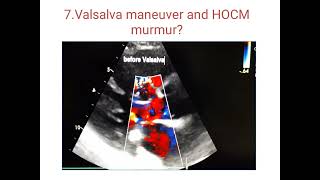 Hypertrophic cardiomyopathy echo  case presentation HOCM cardiology [upl. by Shep]