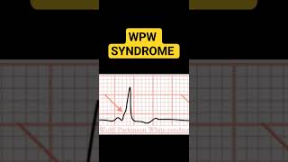 WPW SYNDROME [upl. by Barbee]