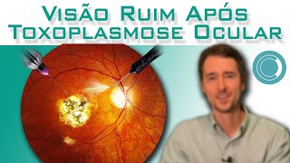 Toxoplasmose Ocular  visão embaçada após o tratamento [upl. by Learsi451]